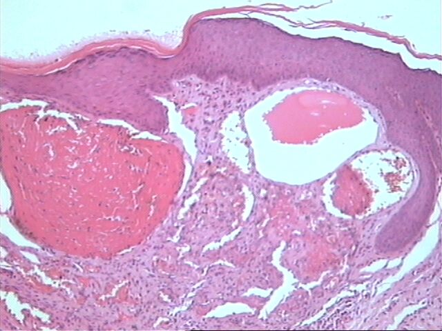 Fig. 4 Angioqueratoma vulvar - <div style=